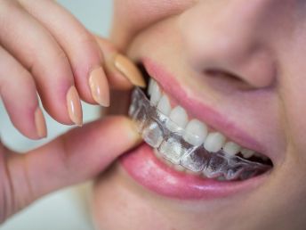 clear aligners